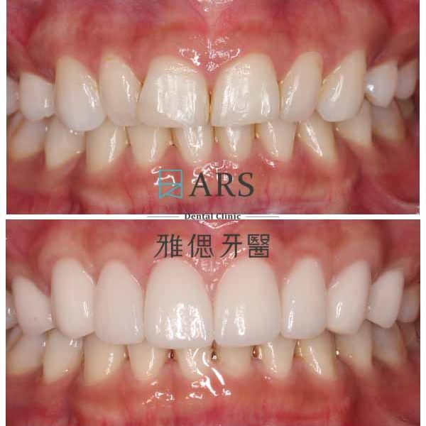 【全瓷冠+水雷射牙冠增長術】 案例3 – 蔡昀蓉醫師