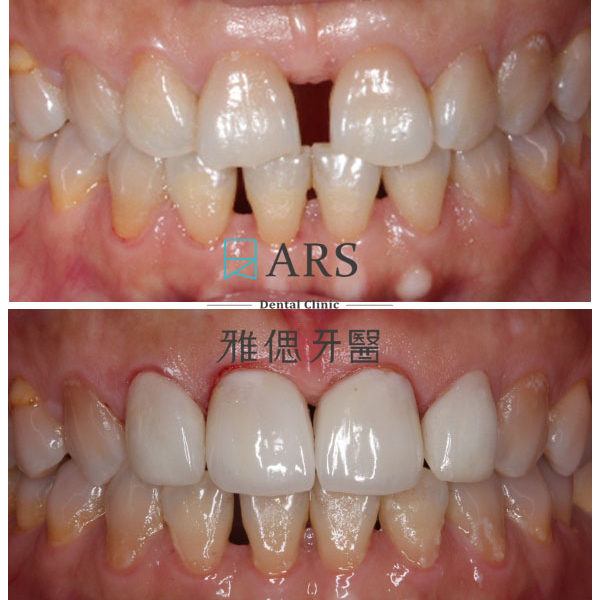 【全瓷冠+陶瓷貼片】 案例12 – 鄭聖達醫師
