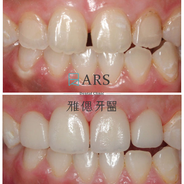 【全瓷冠+陶瓷貼片】 案例13 – 鄭聖達醫師