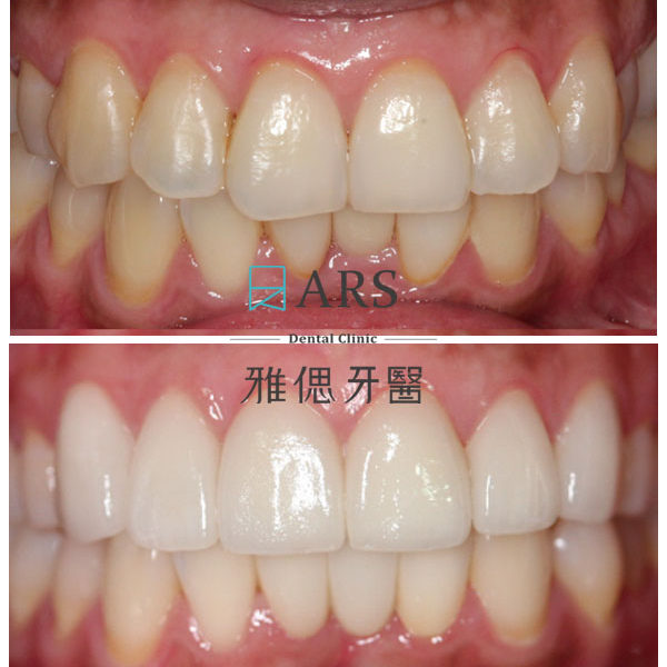 【全瓷冠+陶瓷貼片】 案例14 – 鄭聖達醫師