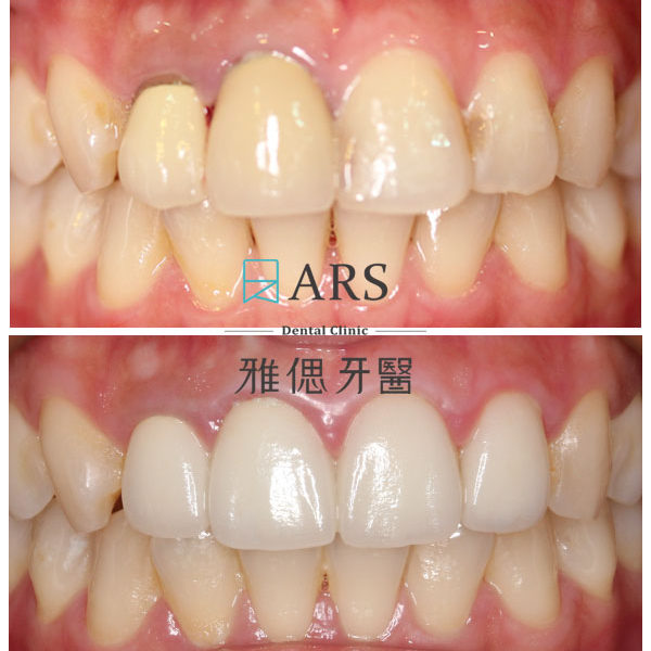 【全瓷冠+陶瓷貼片】 案例16 – 蔡昀蓉醫師
