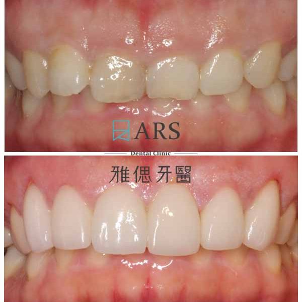 【全瓷冠+陶瓷貼片+水雷射牙冠增長術】 案例3 – 鄭聖達醫師、蔡昀蓉醫師聯合主治