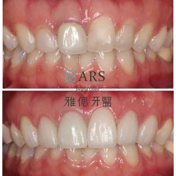 【全瓷冠+陶瓷貼片+水雷射牙冠增長術】 案例4 – 鄭聖達醫師、蔡昀蓉醫師聯合主治
