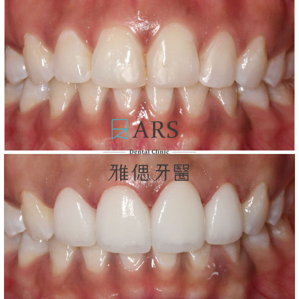 【陶瓷貼片】 案例7 – 蔡昀蓉醫師