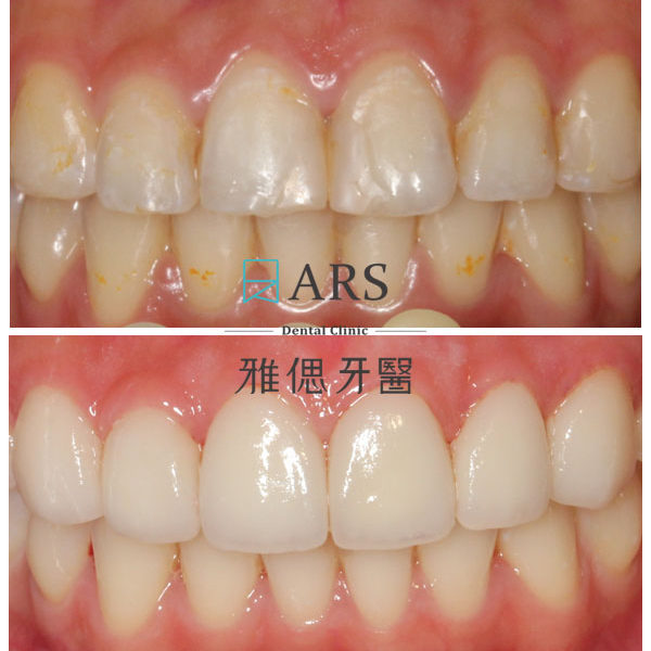 【陶瓷貼片】 案例8 – 蔡昀蓉醫師
