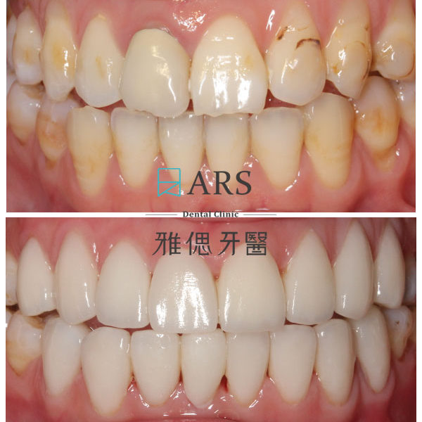 【陶瓷貼片】 案例9 – 蔡昀蓉醫師