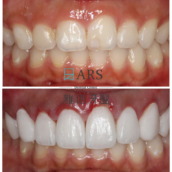 【陶瓷貼片+水雷射牙冠增長術】 案例2 – 鄭聖達醫師