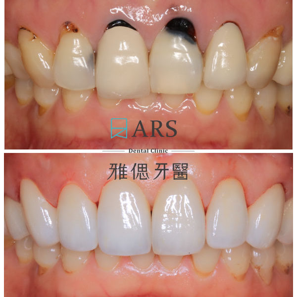 【全瓷冠】 案例11 – 鄭聖達醫師