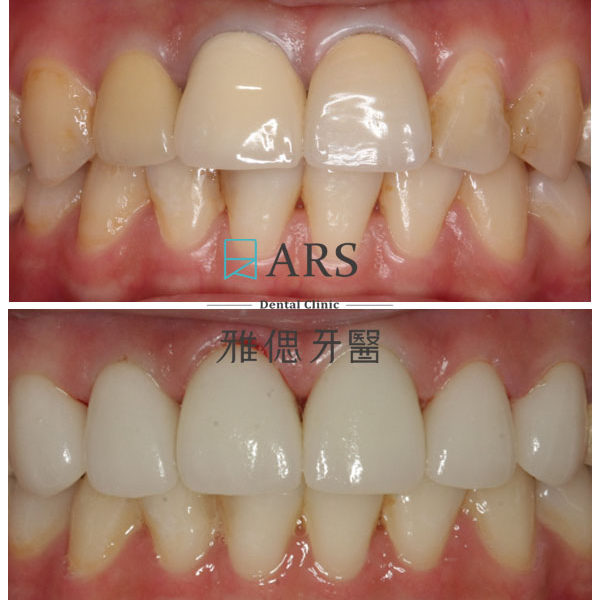 【全瓷冠】 案例12 – 鄭聖達醫師