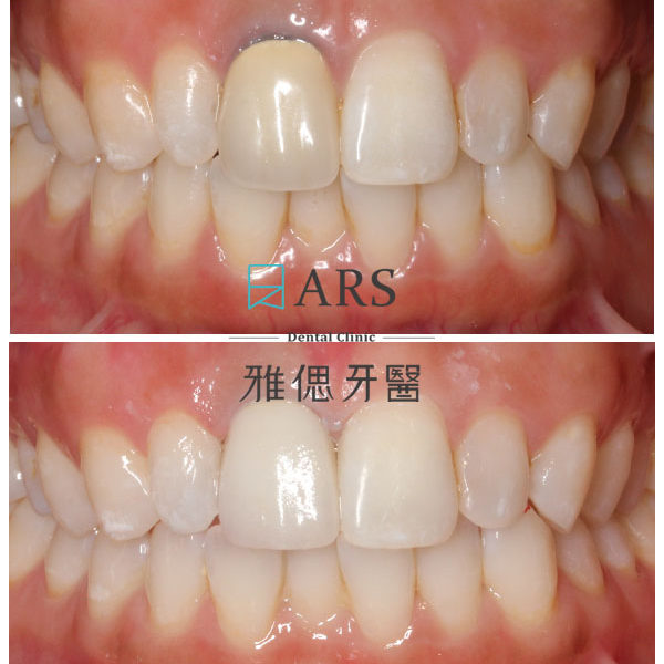 【全瓷冠】 案例17 – 蔡昀蓉醫師