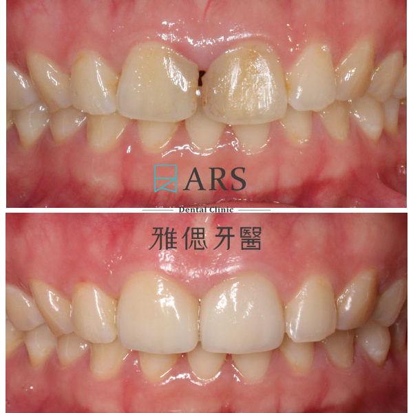 【全瓷冠】 案例18 – 蔡昀蓉醫師