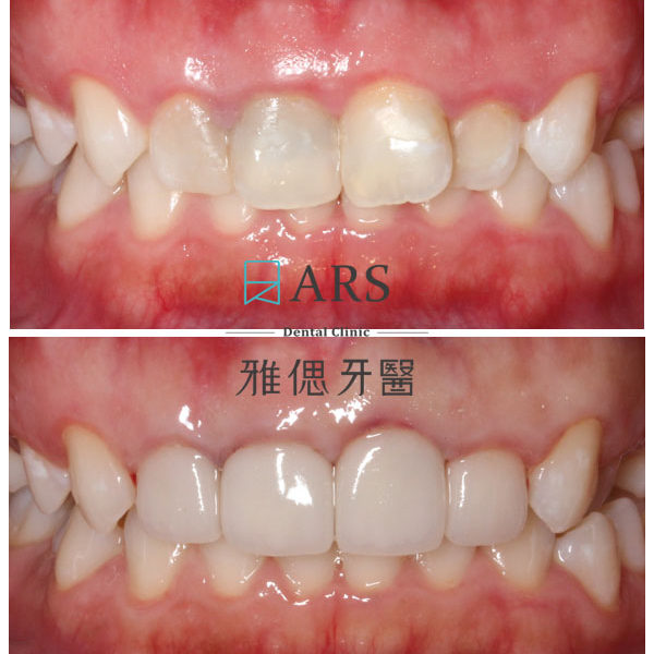 【全瓷冠+陶瓷貼片】 案例17 – 蔡昀蓉醫師