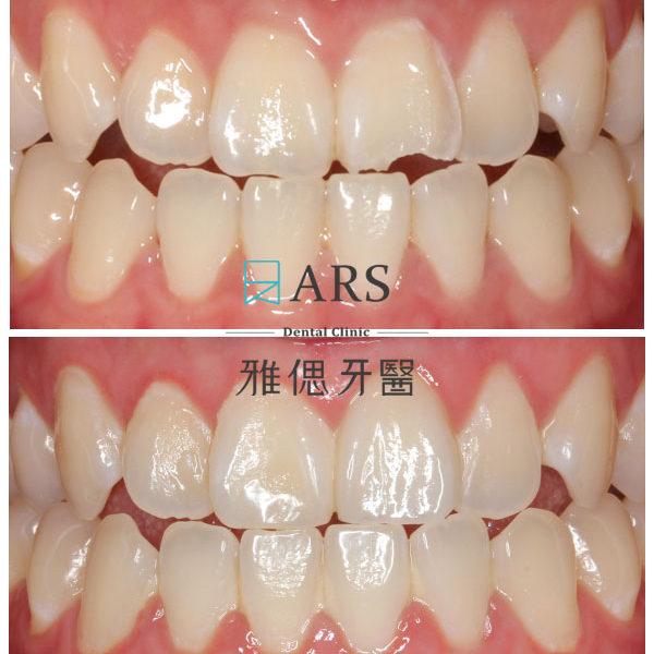 【陶瓷貼片】 案例10 – 蔡昀蓉醫師