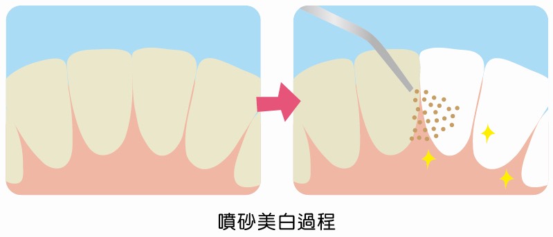 噴砂美白過程