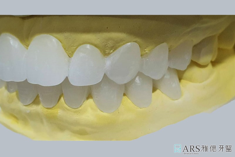 陶瓷貼片 全瓷冠 蠟型模擬