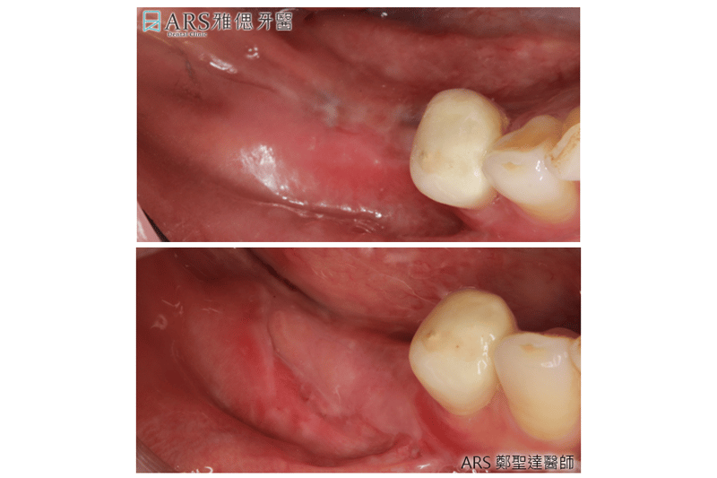 牙齦整形