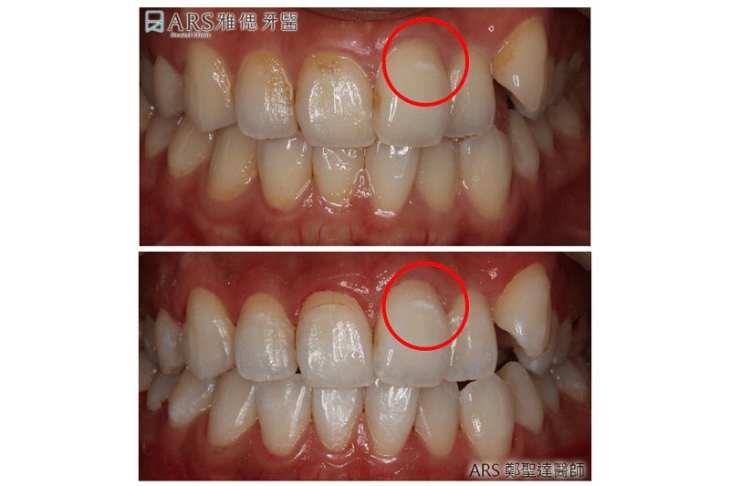 牙齒美白噴砂美白