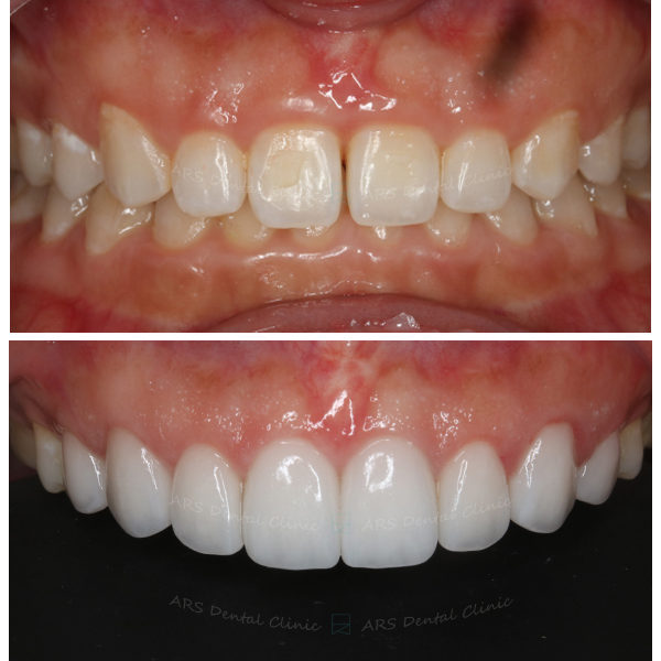 Q-CLS+Veneer#14-#24 (9556) G