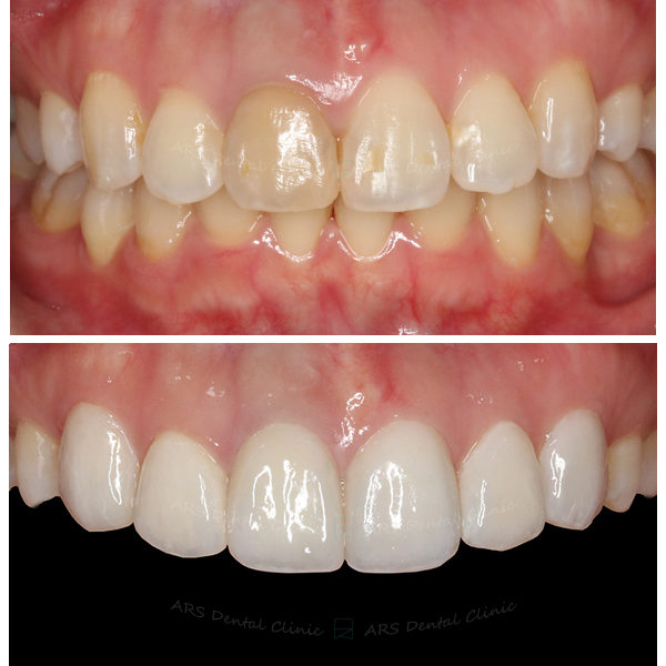 Q-Veneer+全瓷冠#13-#23 (10519) G