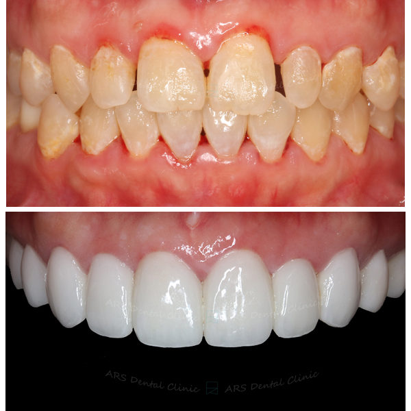 Q-Veneer+全瓷冠#15-#25 (11804) G