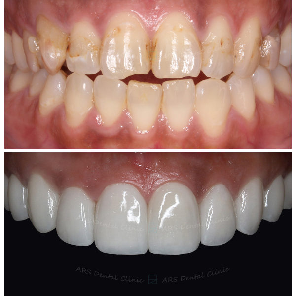 Q-全瓷冠#15-#25 (8460) G