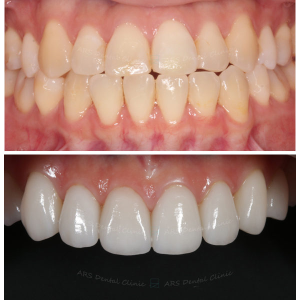 Z-Veneer#14-#24 (1131) G