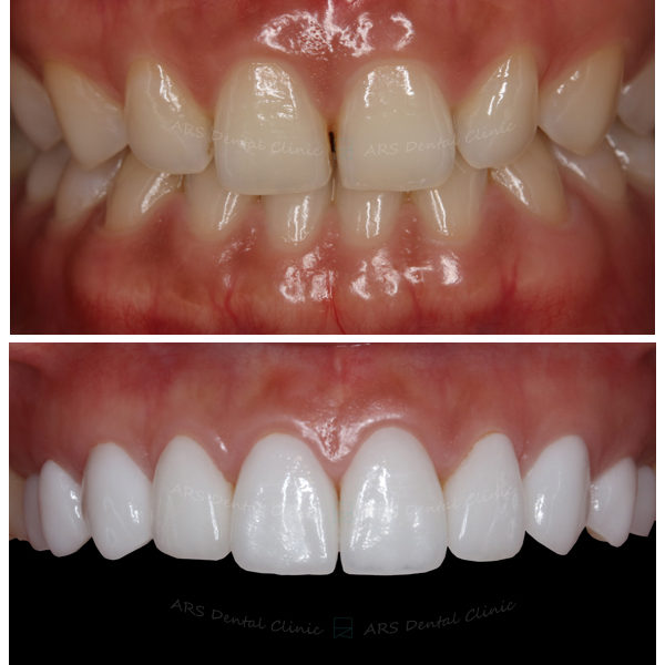 Z-Veneer+全瓷冠#15-#25 (6843) G