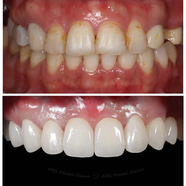 Z-ortho+全瓷冠#14-#25 (8001) G