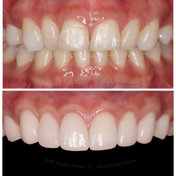 Q-C.L.S#15-#25&全瓷冠#15-#25 (5724) G