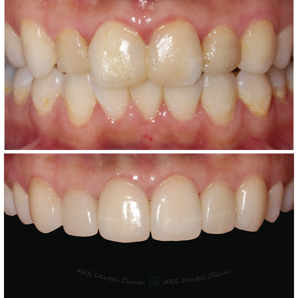 Q-Veneer+全瓷冠#13-#23 (1491) G