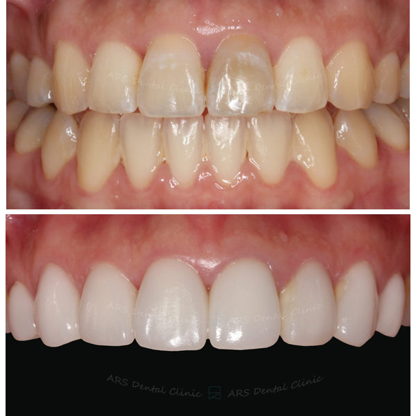 Q-Veneer+全瓷冠#14-#24 (1756) G