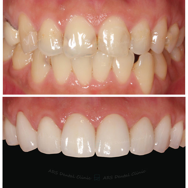 Q-Veneer+全瓷冠#14-#24 (4741) G