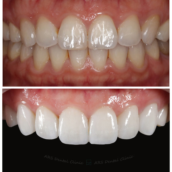 Z-Veneer#15-#25 (11987) G