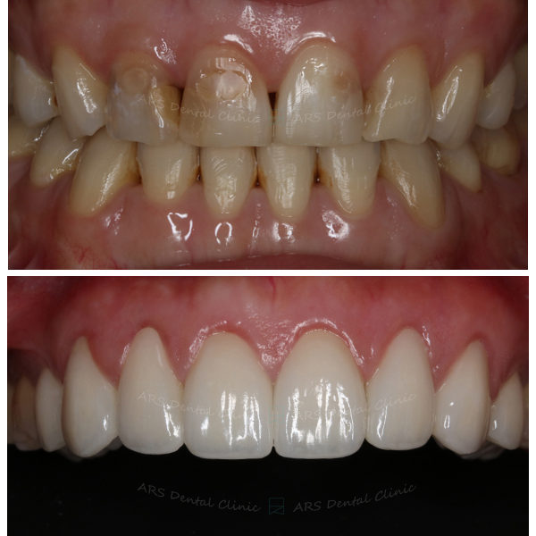 Z-全瓷冠#14-#24 (12080) G