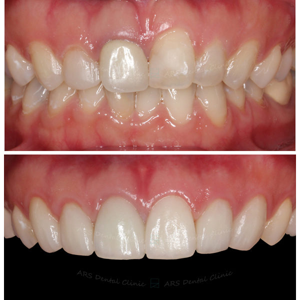Z+Q-C.L.S#14-#24&Veneer+全瓷冠#14-#24 (1032) G