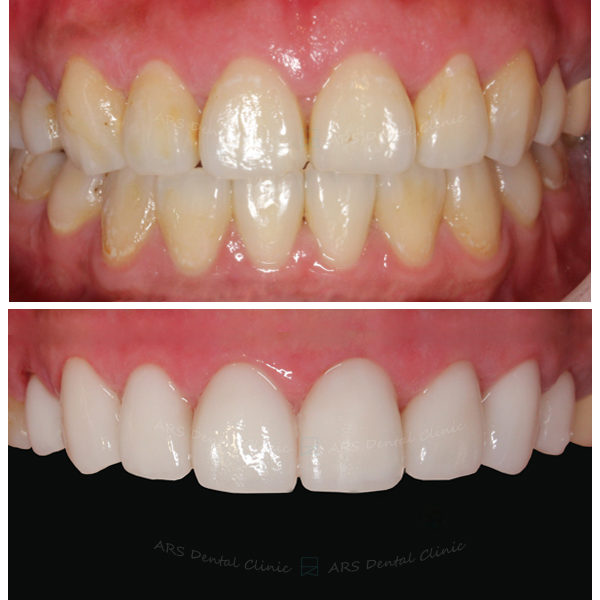 Z+Q-C.L.S#14-#24&Veneer+全瓷冠#14-#24+#34-#44 (4805) G