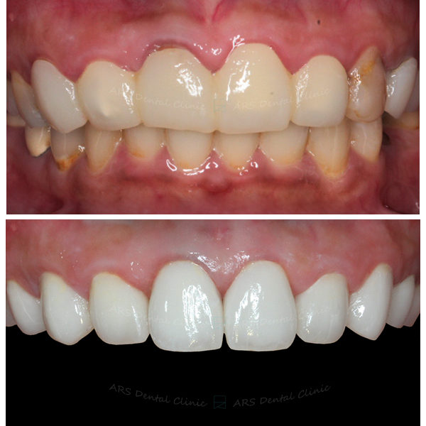 Q-C.L.S#14-#24&全瓷冠#14-#24 (3006) G