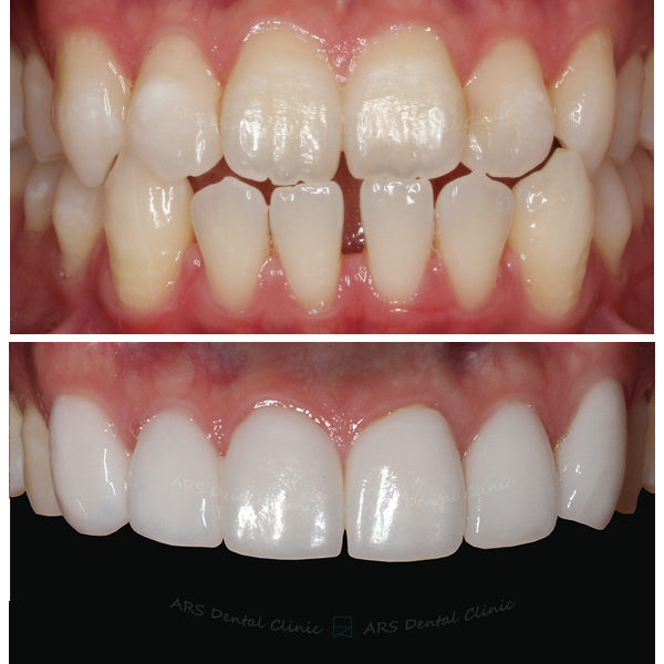 Q-Veneer#13-#23 (1384) G