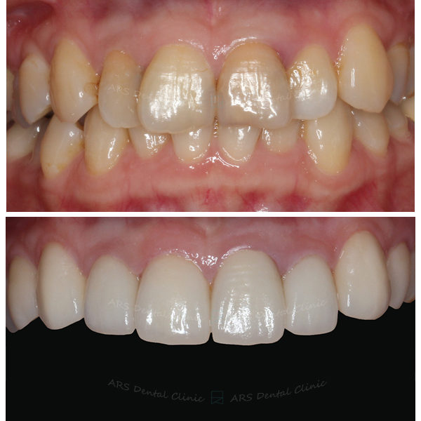 Q-Veneer#14-#24 (2157) G