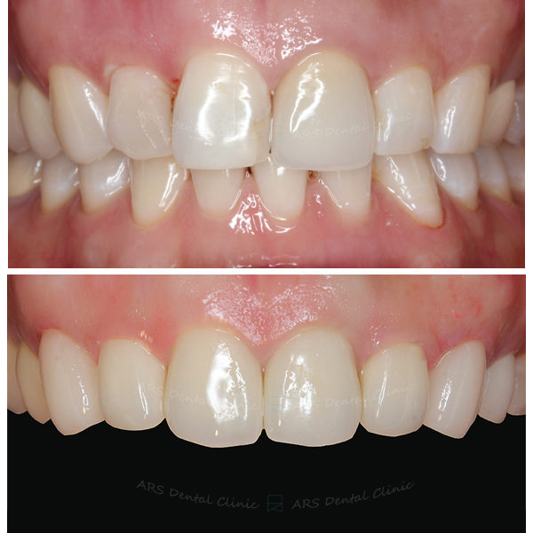 Q-Veneer+全瓷冠#13-#24 (6284) G