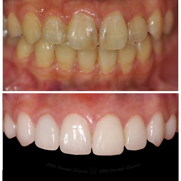 Q-Veneer+全瓷冠#14-#24 (1267) G