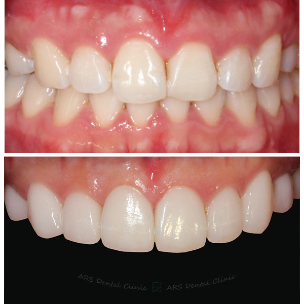 Q-Veneer+全瓷冠#14-#24 (3711) G