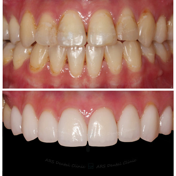 Q-Veneer+全瓷冠#14-#24 (4029) G