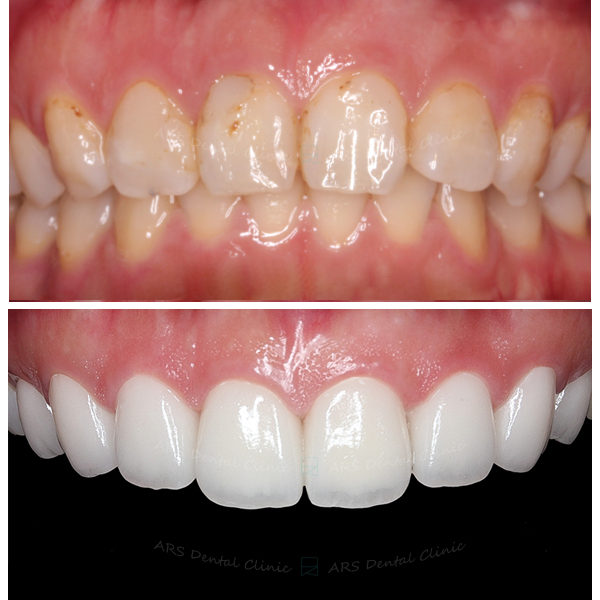 Q-Veneer+全瓷冠#14-#24 (6663) G