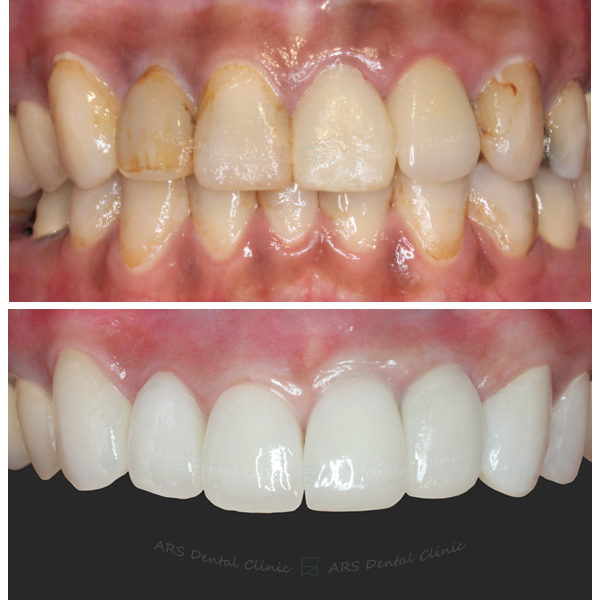 Q-C.L.S#11#22&全瓷冠#13-#24 (6228) G