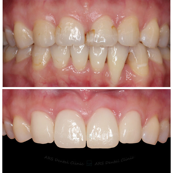 Q-C.L.S#12-#22&全瓷冠#12-#22 (5714) G