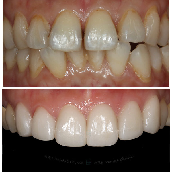 Q-Veneer#13-#23 (11396) G