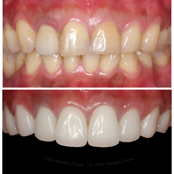 Q-Veneer+全瓷冠#14-#24 (6411) G