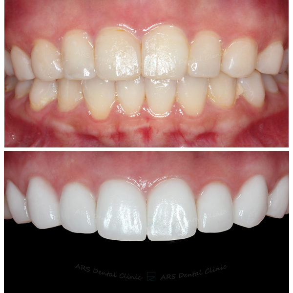 Q+C-C.L.S#14-#24&Veneer#14-#24 (7710) G