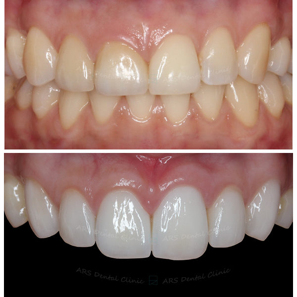 Q-C.L.S#12-#21&Veneer#13-#23 (4253) G